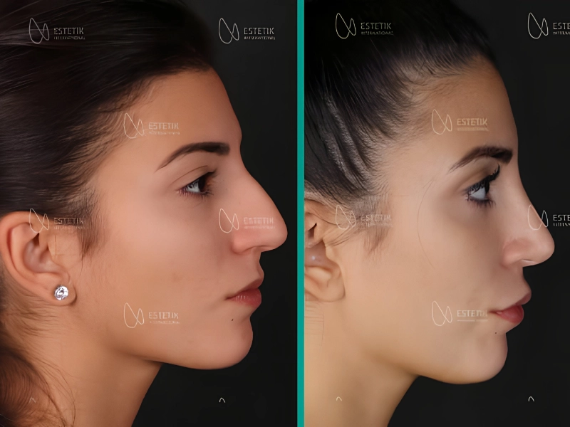 Female patient's side profile before and after septorhinoplasty and turbinate reduction