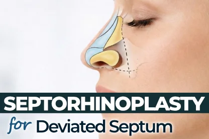 Professional medical illustration demonstrating deviated septum correction, turbinate reduction, and septorhinoplasty anatomy.