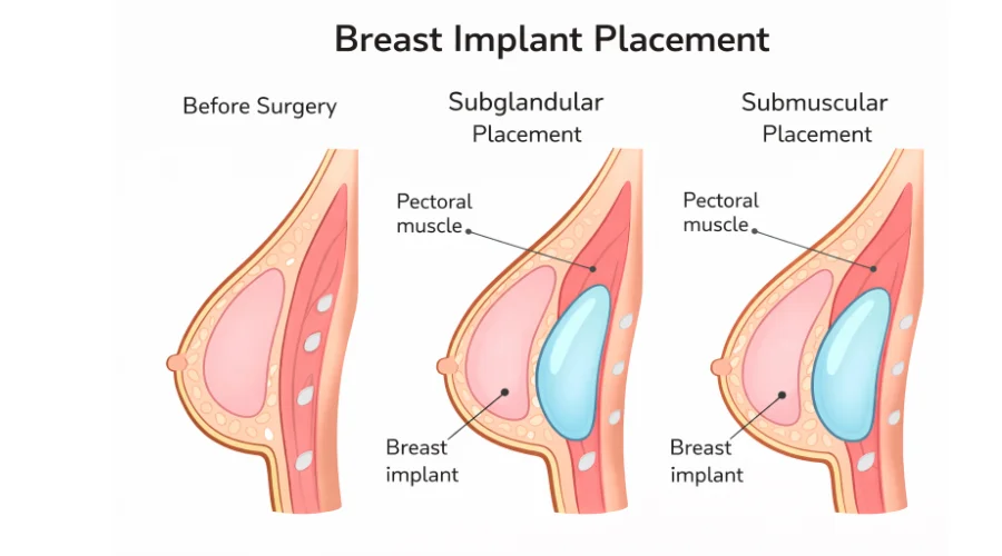 Teardrop vs Round Breast Implants Comparison