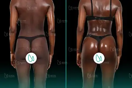 Brazilian Butt Lift before and after