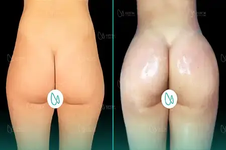 Brazilian Butt Lift before and after