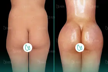 Brazilian Butt Lift before and after