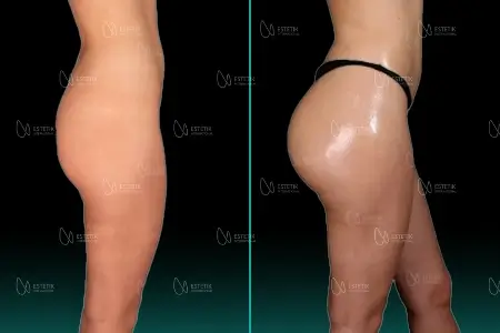 Brazilian Butt Lift before and after