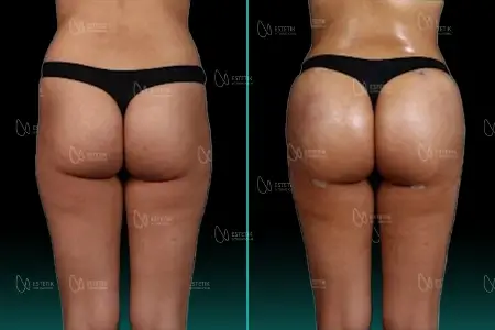 Brazilian Butt Lift before and after