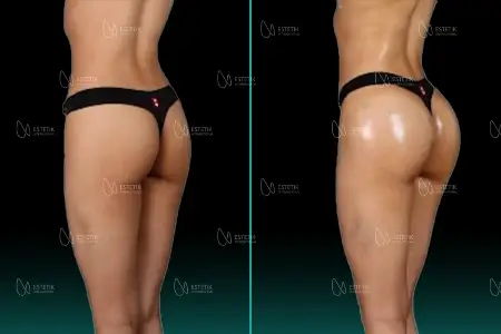 Brazilian Butt Lift before and after