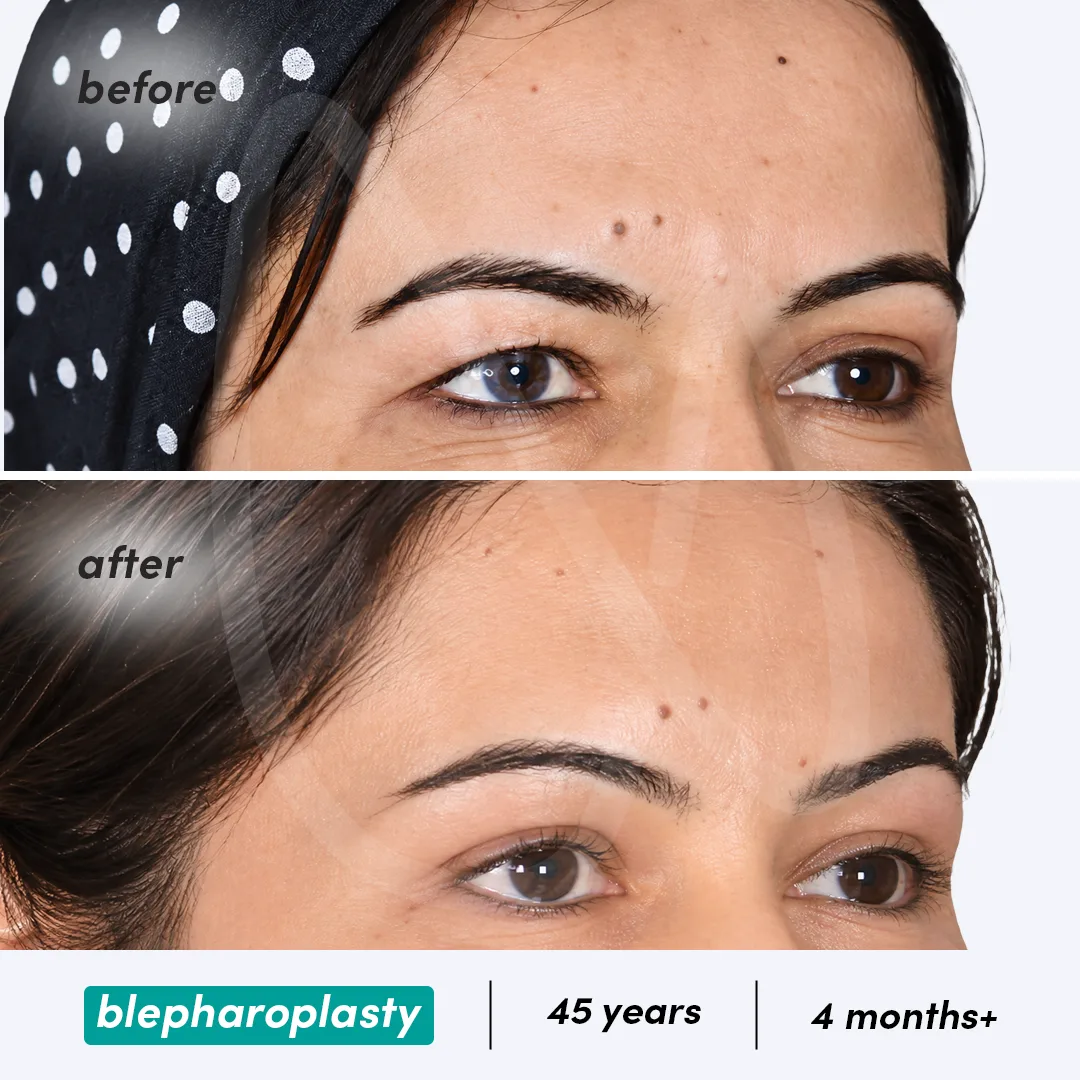 Blepharoplasty before and after