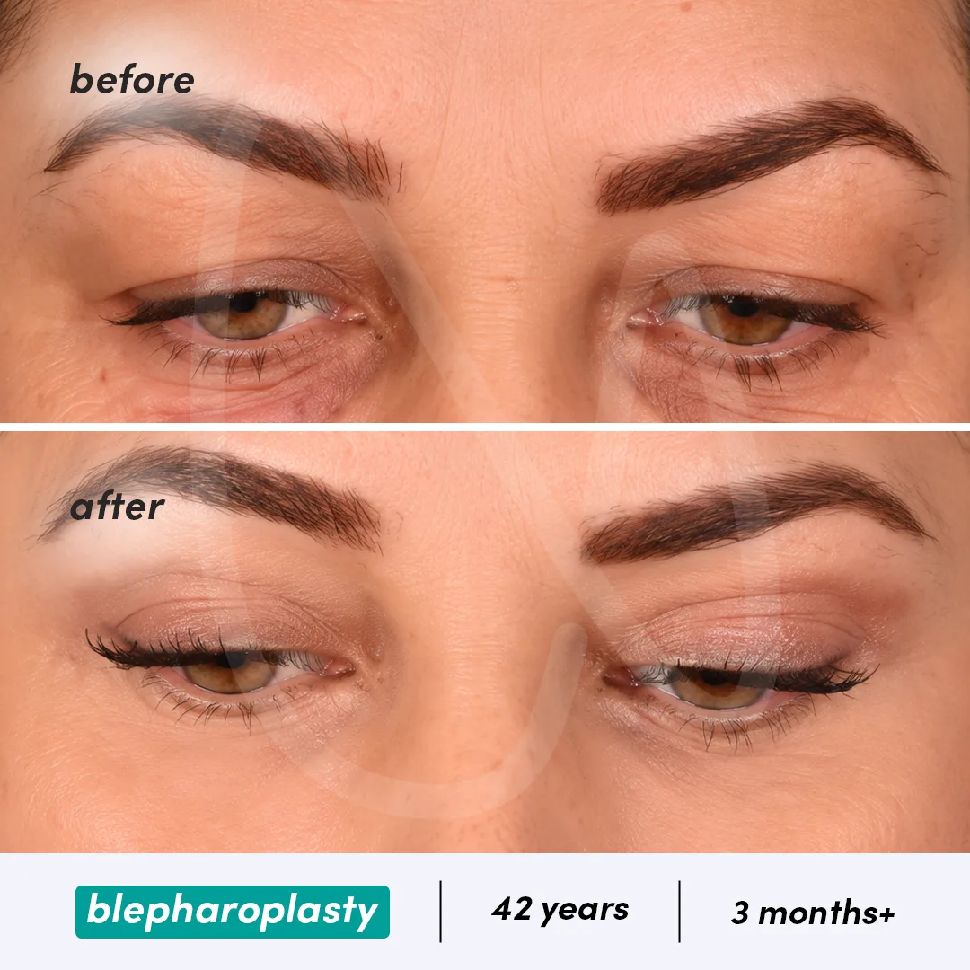 Blepharoplasty before and after