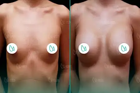 Augmentation Mammaire before and after