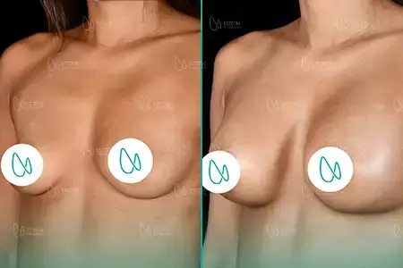 Augmentation Mammaire before and after