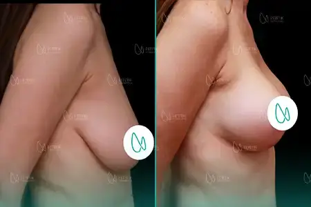 Augmentation Mammaire before and after