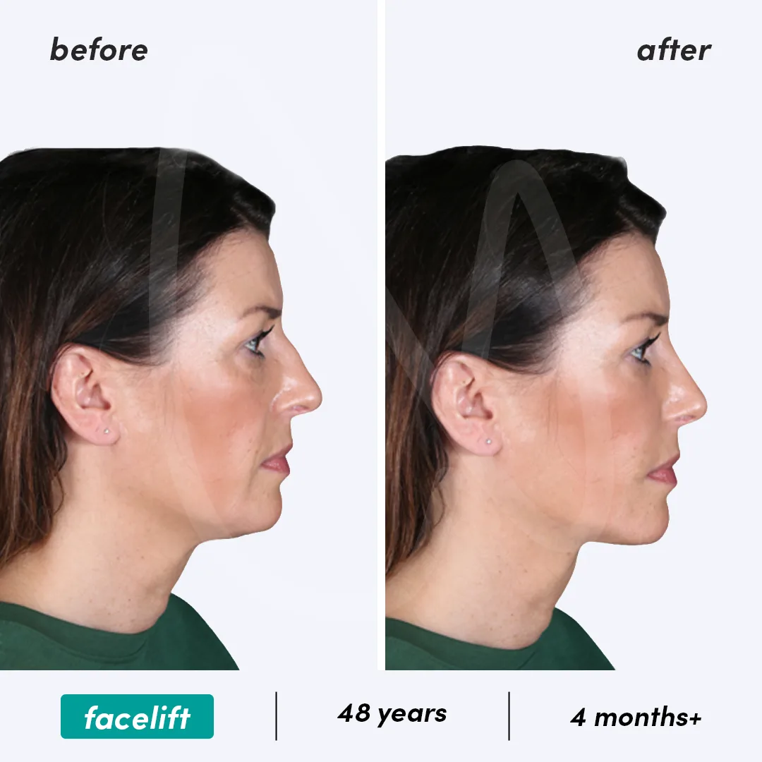Facelift before and after