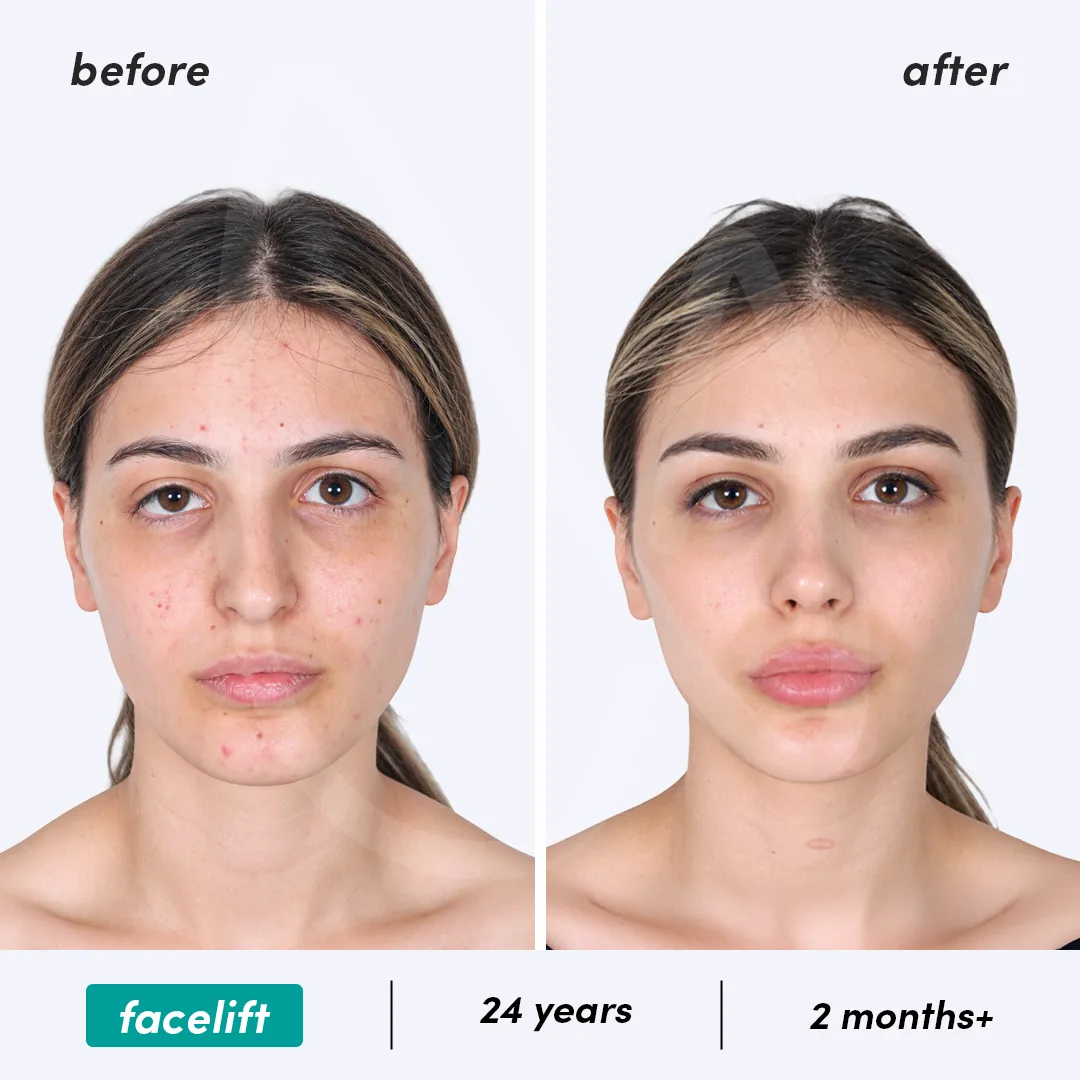Facelift before and after