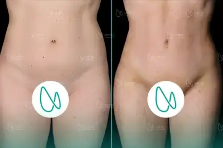 Liposuccion before and after