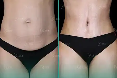 Liposuccion before and after