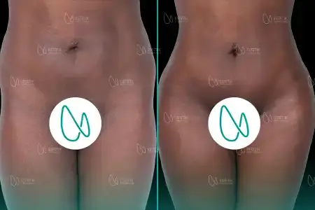 Liposuccion before and after