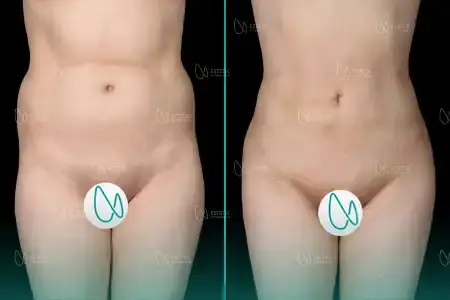 Liposuccion before and after