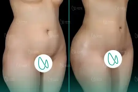 Liposuccion before and after