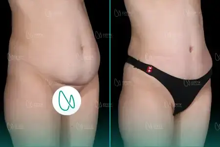 Liposuccion before and after
