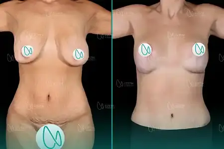 Mommy Makeover before and after
