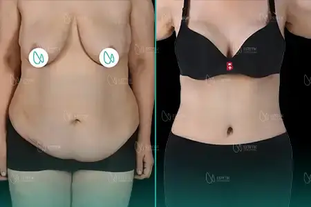 Mommy Makeover before and after