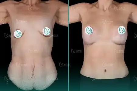 Mommy Makeover before and after