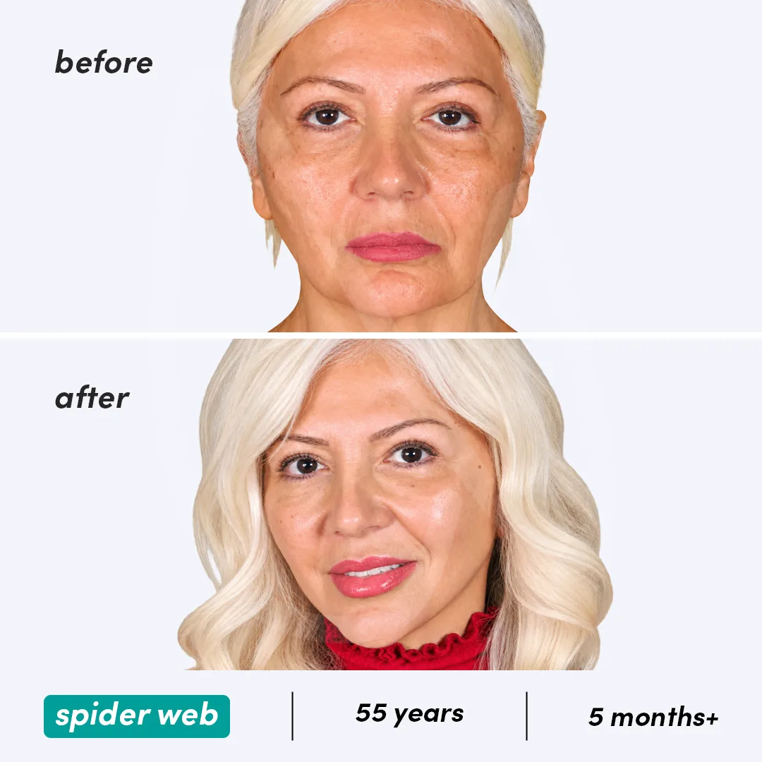 Spider Web Technique before and after