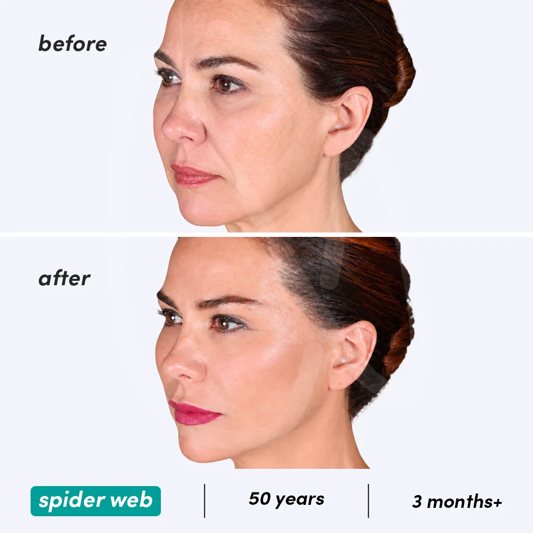 Spider Web Technique before and after