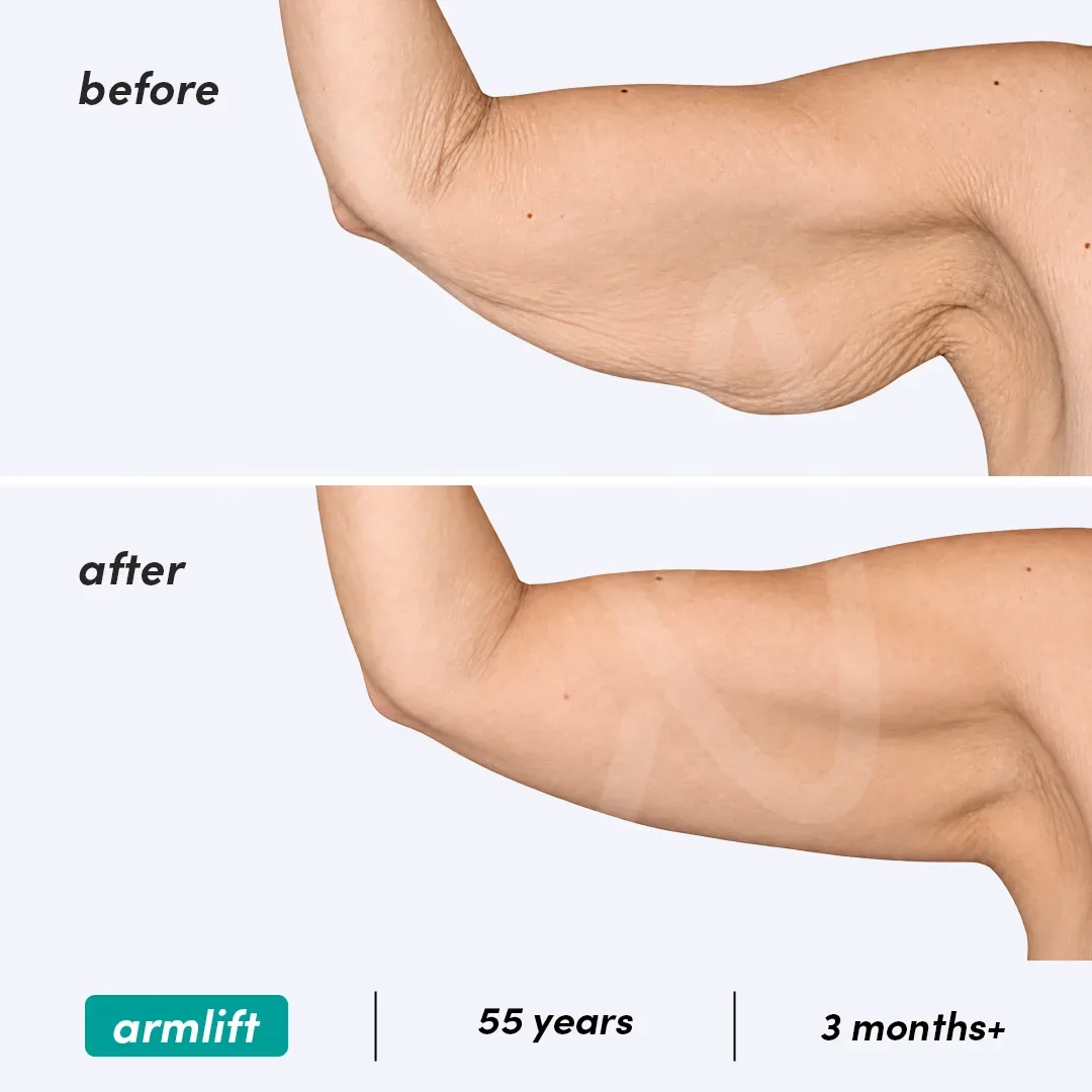 Lifting des Bras before and after