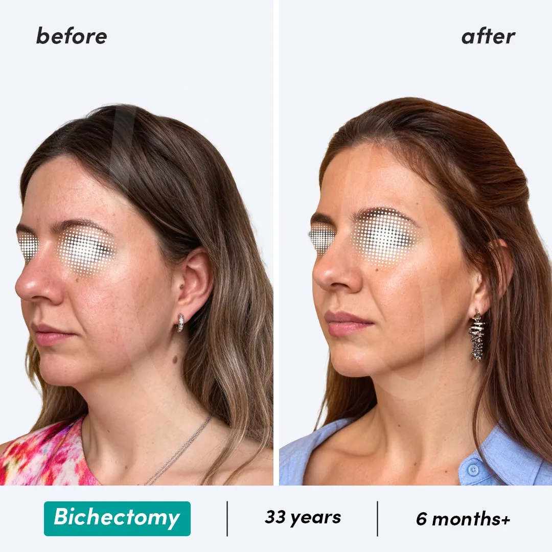 Bichectomy before and after
