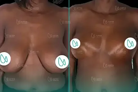 Réduction Mammaire before and after