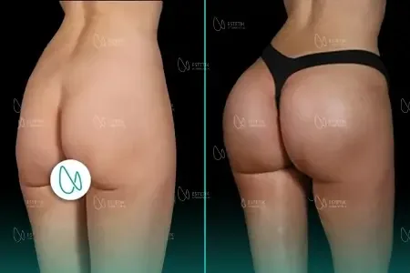 Implants Fessiers before and after