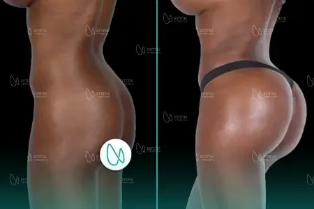 Implants Fessiers before and after