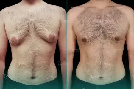 Gynécomastie before and after