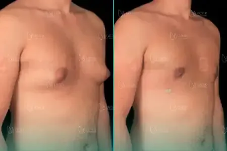 Gynécomastie before and after