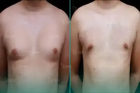 Gynécomastie before and after