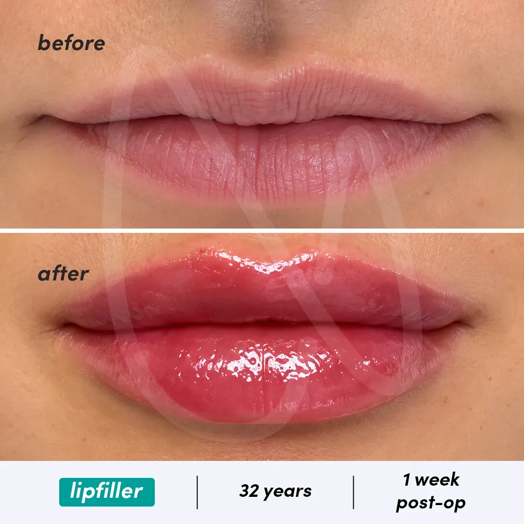 Acide Hyaluronique Lèvres before and after