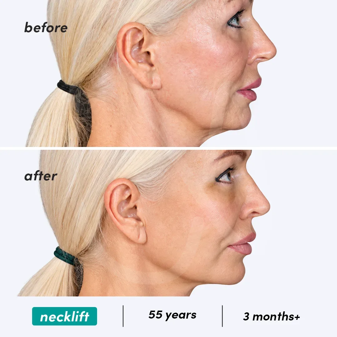 Lifting du Cou before and after