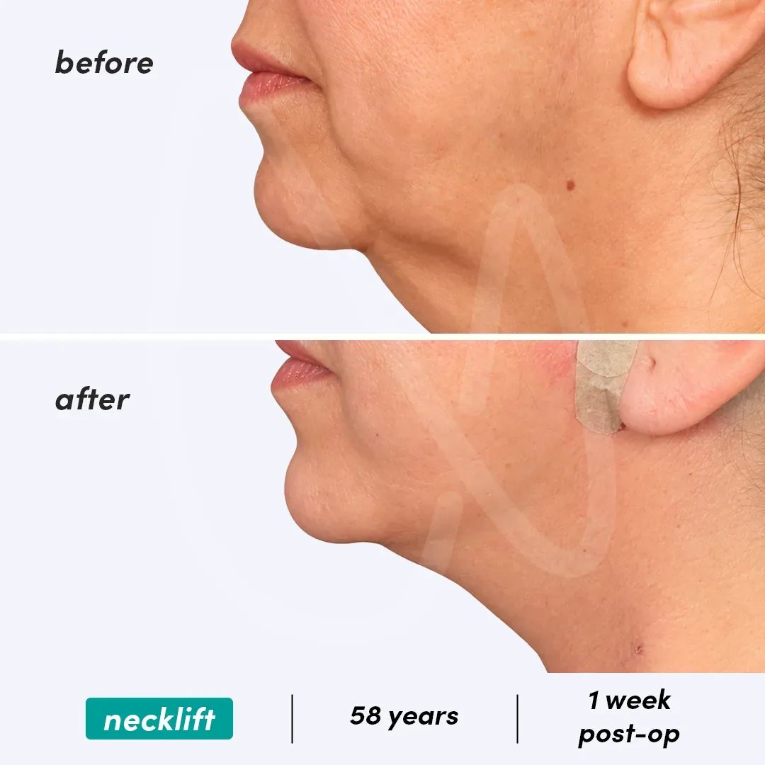 Lifting du Cou before and after