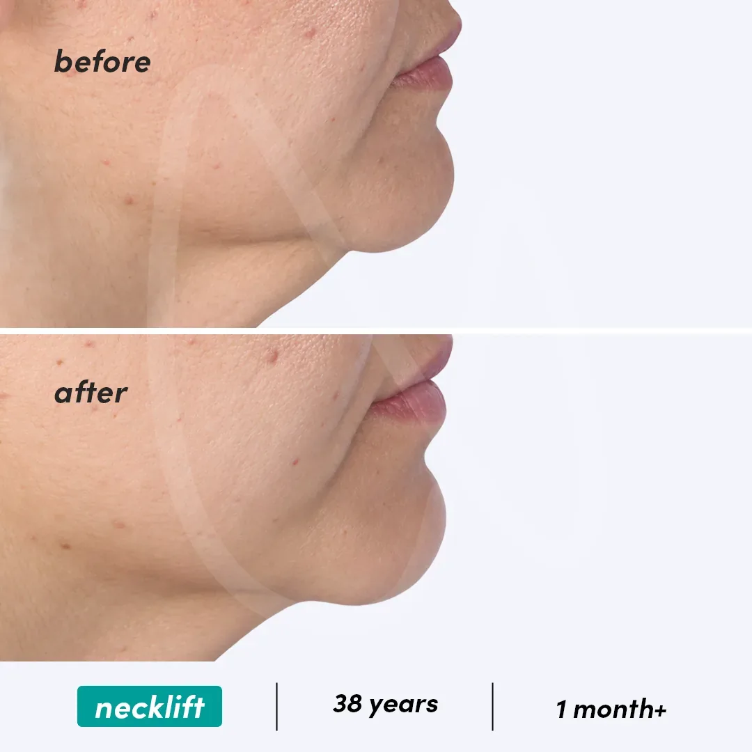 Lifting du Cou before and after