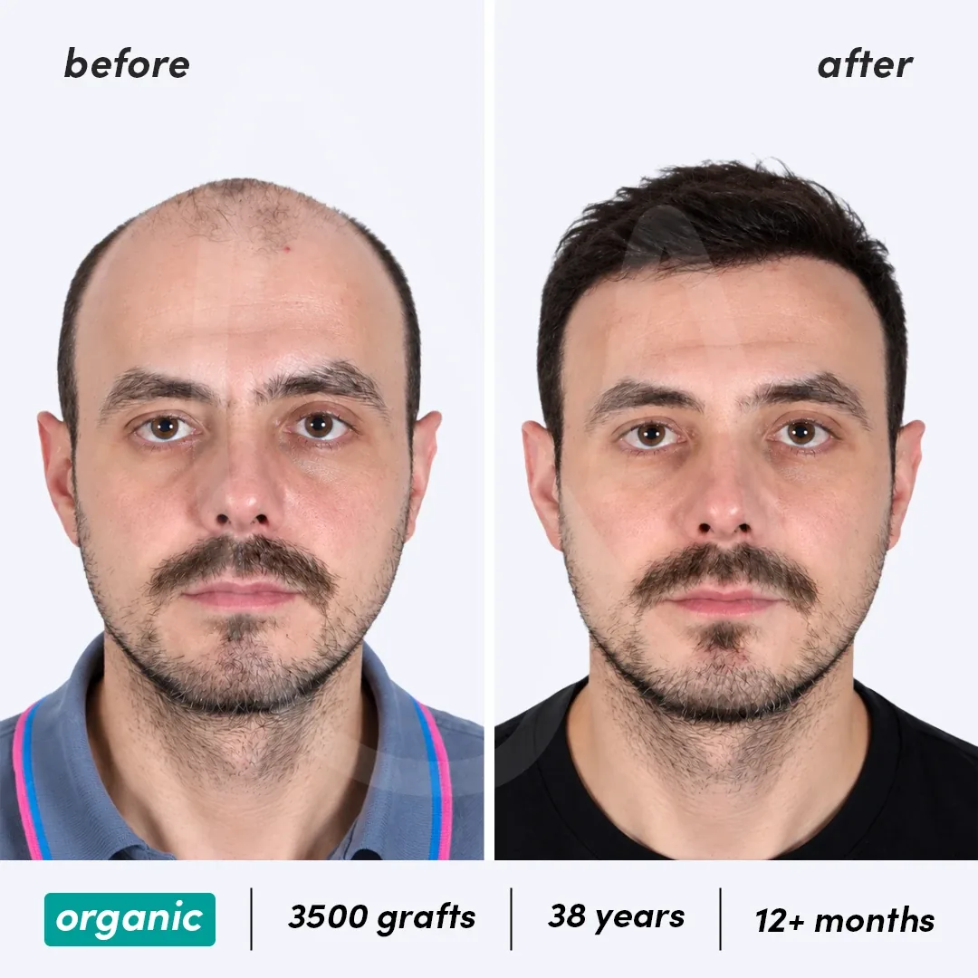 Transplantation Capillaire Organique before and after