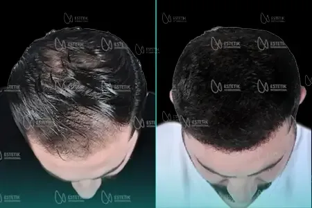 Transplantation Capillaire Organique before and after
