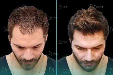 Transplantation Capillaire Organique before and after