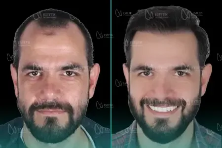 Transplantation Capillaire Organique before and after
