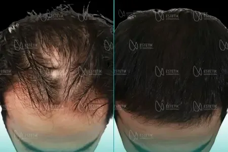 Transplantation Capillaire Organique before and after