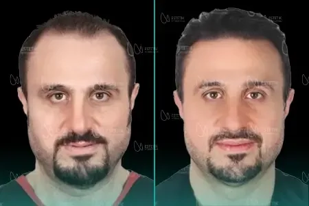 Transplantation Capillaire Organique before and after
