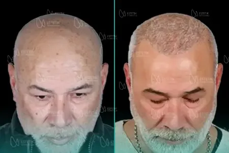 Transplantation Capillaire Organique before and after