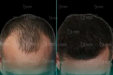 Transplantation Capillaire Organique before and after
