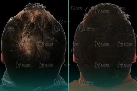 Transplantation Capillaire Organique before and after