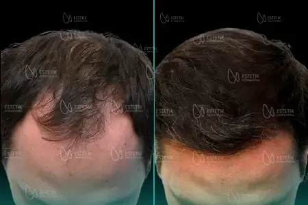 Transplantation Capillaire Organique before and after