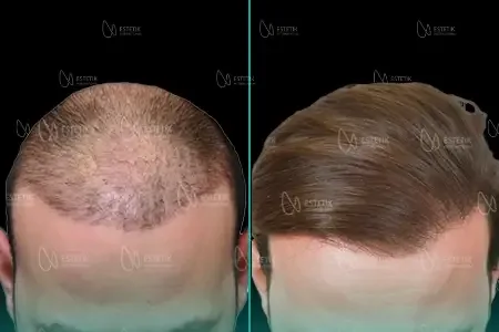 Transplantation Capillaire Organique before and after